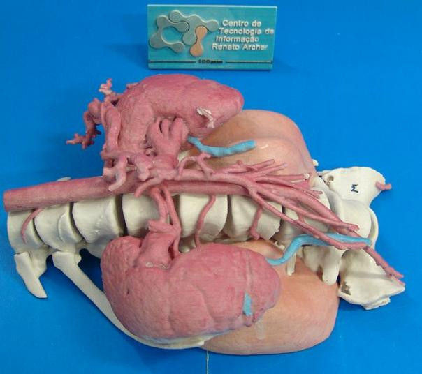 A 3D-printed model of a 12-year-old girl's spine, which shows a tumour affecting nearby organs and arteries
