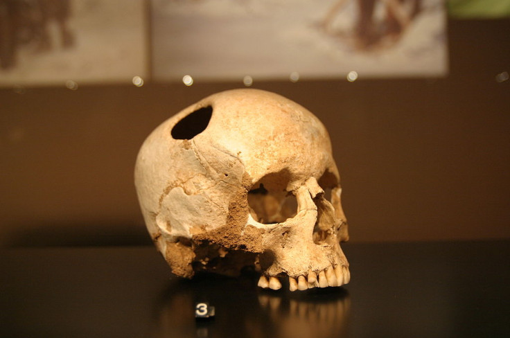 Trepanation - an ancient, highly risky head trauma treatment involving drilling or scraping a hole in the skull