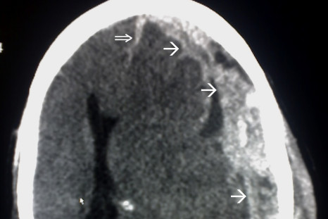 A CT scan of a subdural haematoma