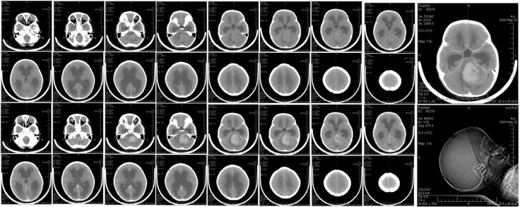 Medulloblastoma