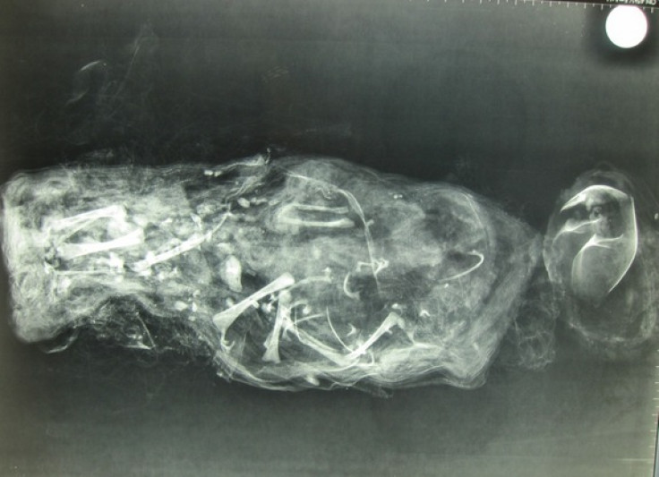 X-ray of mummified foetus