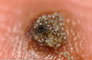 The eggs hatching from a cigoe flea The eggs hatching from a cigoe flea
