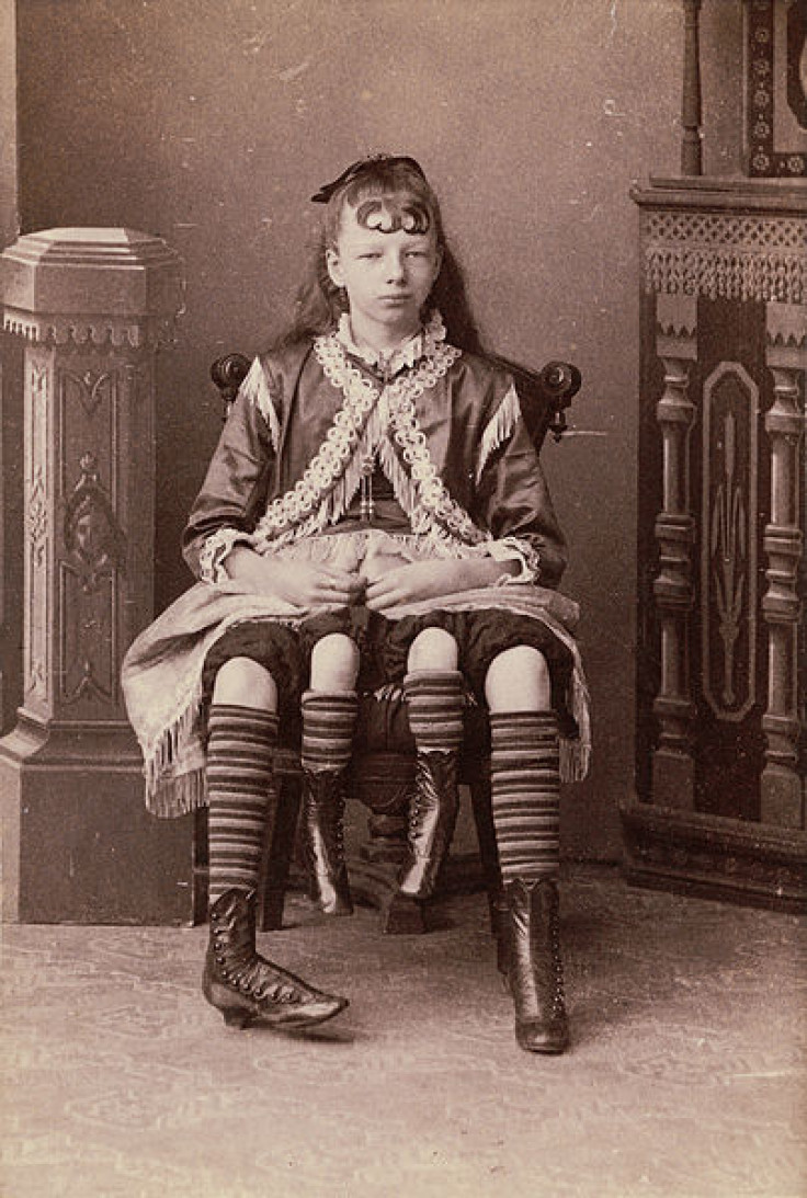 Myrtle Corbin, the "Four-Legged Girl from Texas"
