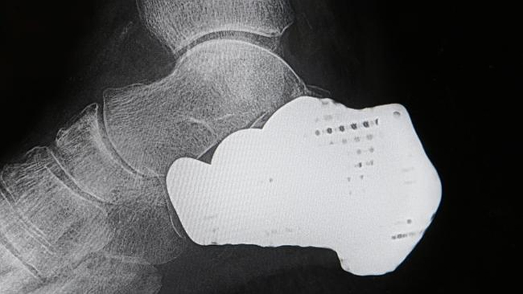 3D-Printed Heel Bone Saves Cancer Patient's Leg From Amputation in