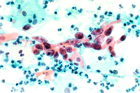 Cytological Specimen Showing Cervical Cancer