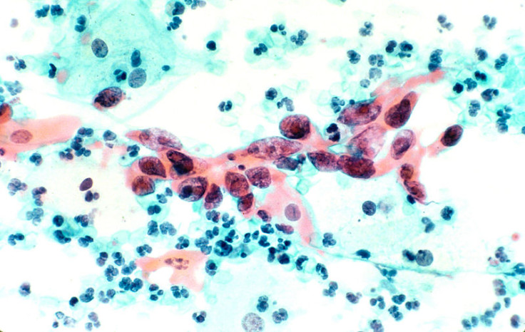 Cytological Specimen Showing Cervical Cancer