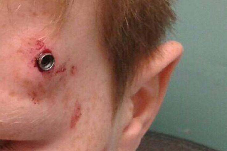 Horrific injury of Durham schoolboy shot with an airgun