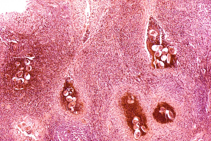 Bilharzia: photomicrography of infected bladder showing clusters of the parasite eggs