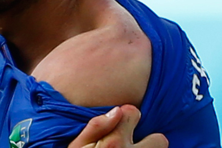 June 24, 2014: Italy's Giorgio Chiellini shows teeth marks on his shoulder where he was bitten by Uruguay's Luis Suarez, during their 2014 World Cup match at the Dunas arena in Natal, Brazil