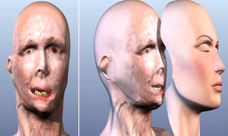 Full facial transplants: A new medical technique where a donor's face can be used to rebuild the faces of patients with horrific facial injuries