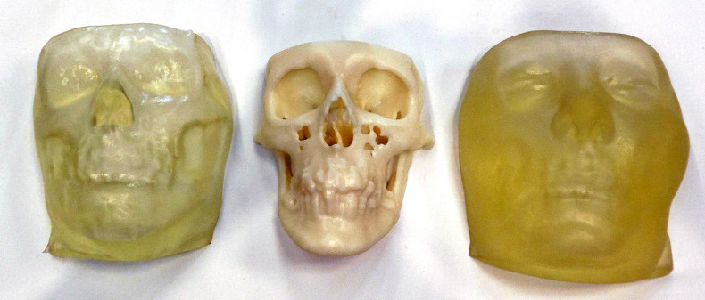 3D-printed face models of Carmen Tarleton: (from left), Tarleton's face and bone models prior to the surgery,