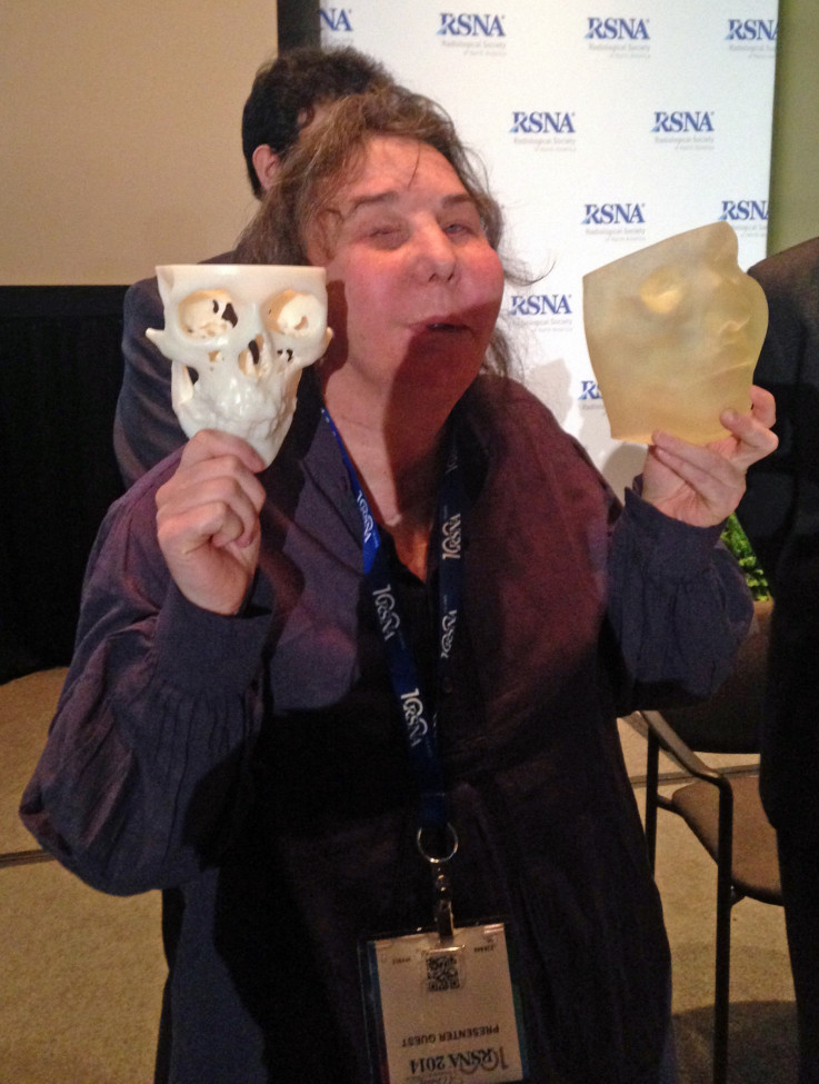 Carmen Tarleton today, showing the success of her full facial transplant at the RSNA conference