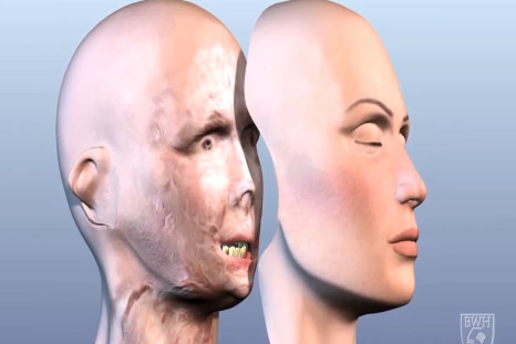 3D printing used in full face transplants