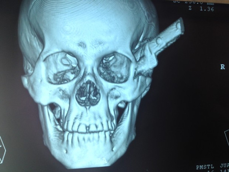 A Brazilian man has survived an attack that left a blade embedded in his skull