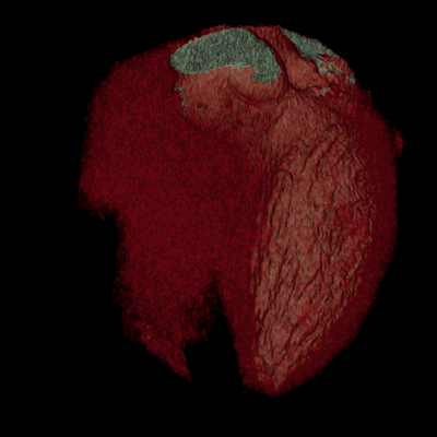 A 4D model of a pumping heart, with stents typically used to treat narrow or weak arteries