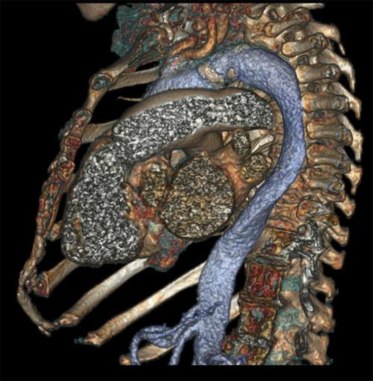 A side view of the chest cavity, including the heart