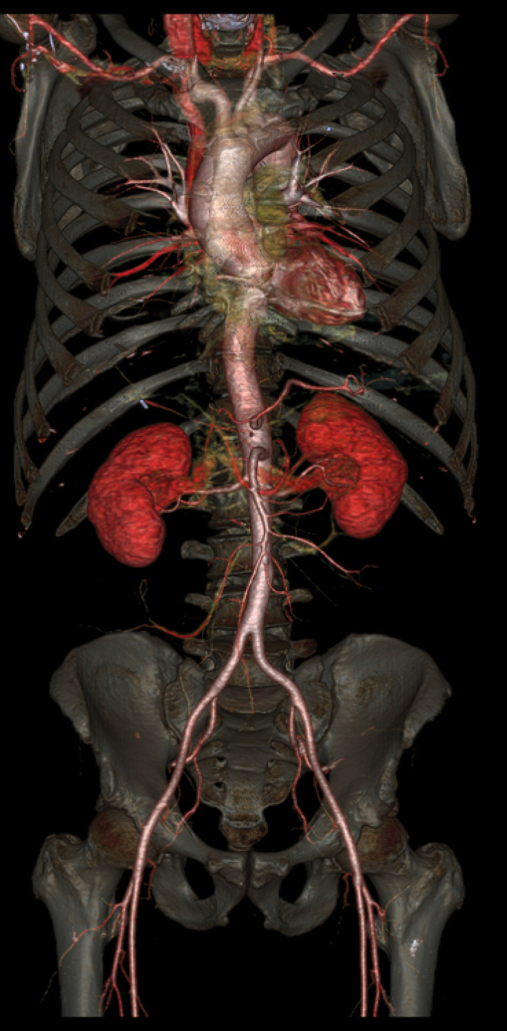 An image showing the whole aorta (main artery in the human body) and the kidneys