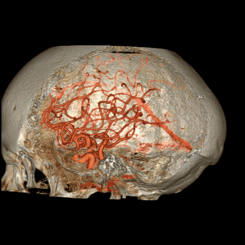 A 4D model of the skull, showing the circle of willis (circulus arteriosus cerebri), which supplies blood to the brain