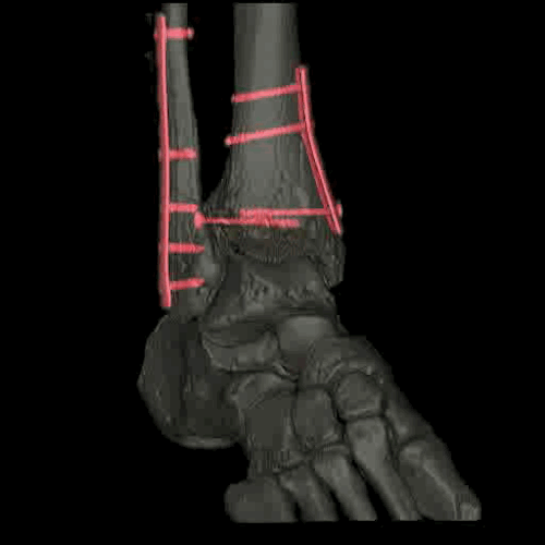 A 4D model of a foot that has been reinforced with medical screws