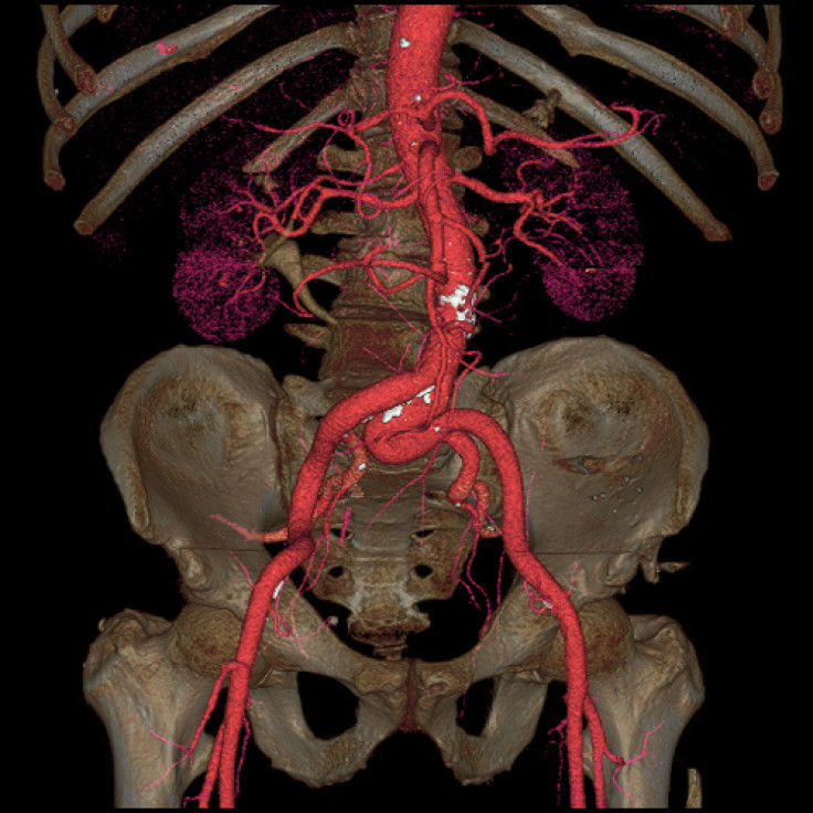 An image showing the pelvis and the aorta, the main artery in the human body