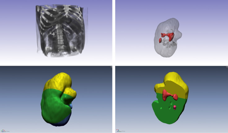 The process of making a 3D-printed kidney