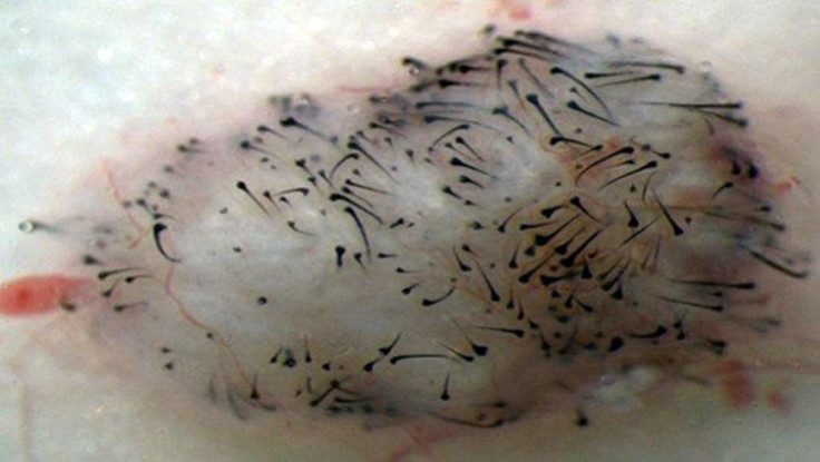 Scientists have worked out how to get human pluripotent stem cells to become dermal cells, and successfully grew hair in mice
