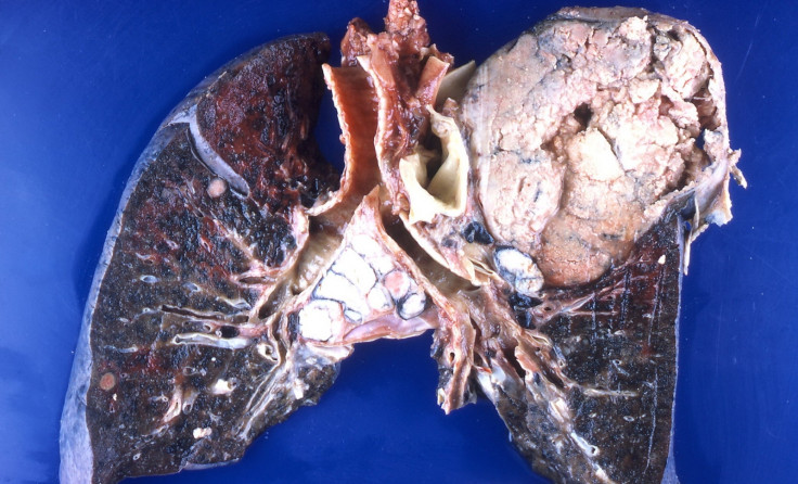 lung cancer