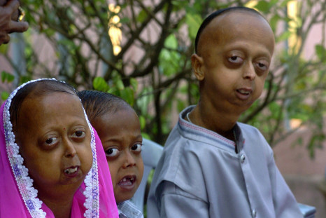 Progeria disease