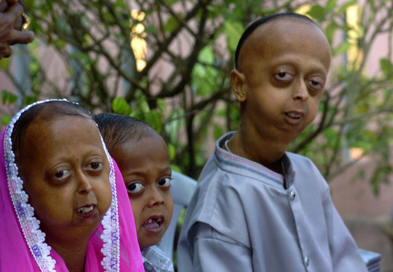 Progeria disease