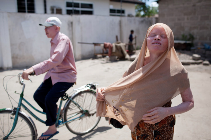 Albinos Tanzania