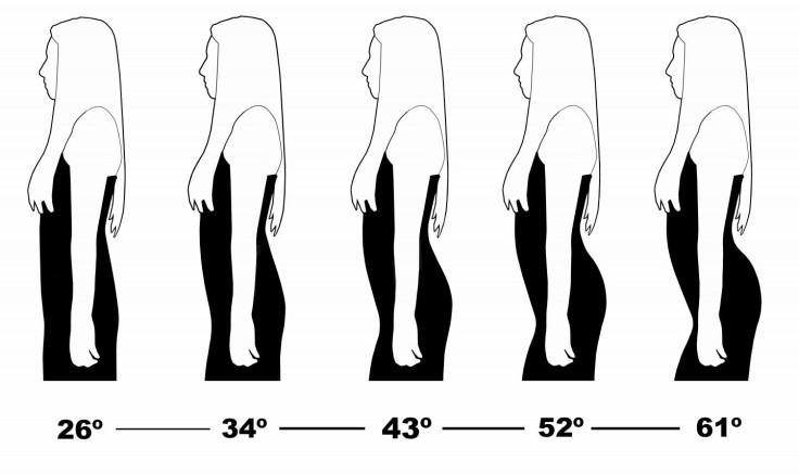 spinal curve