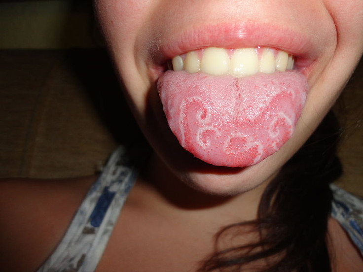 geographic tongue