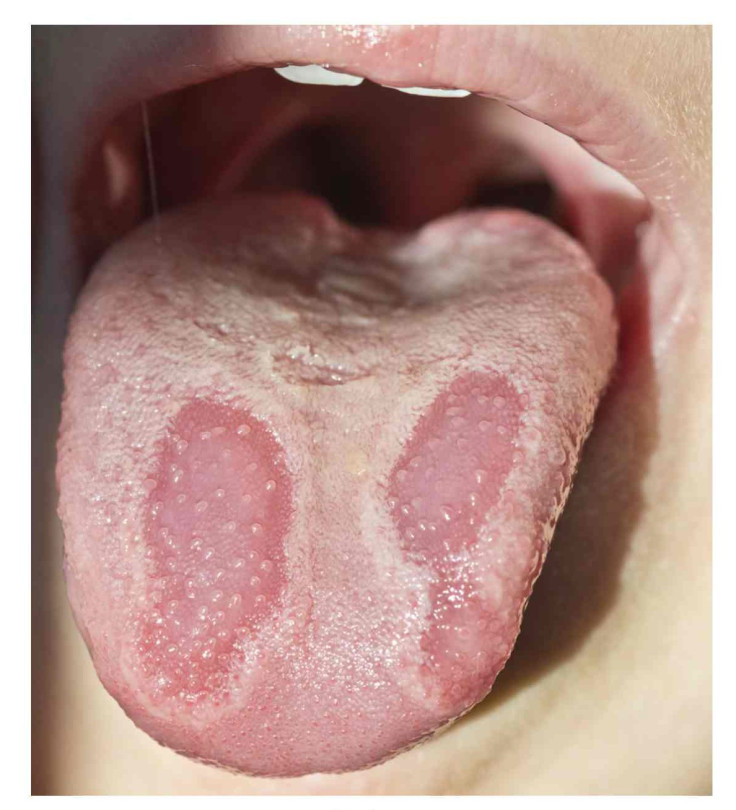 geographic tongue
