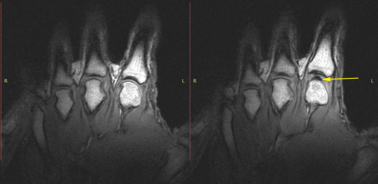 why do knuckles crack?