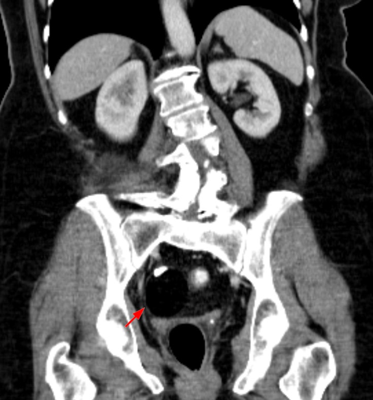 Teratoma