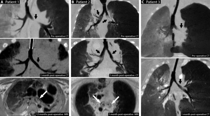 Tracheobronchomalacia