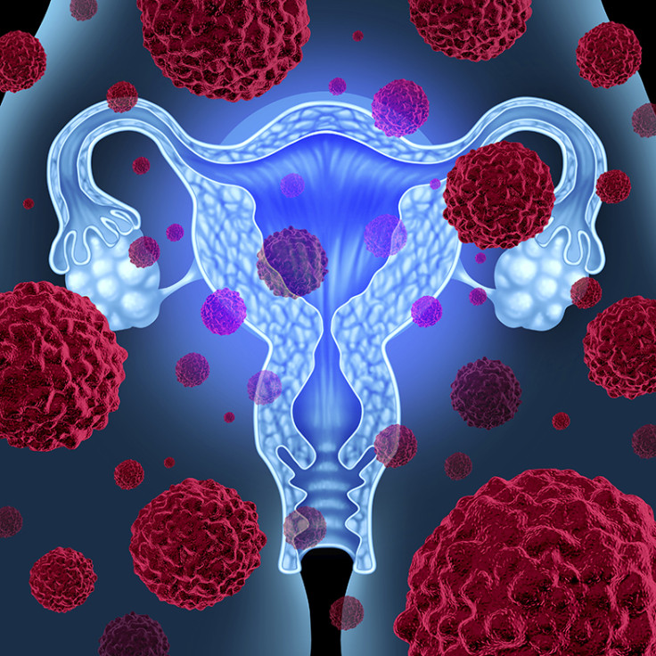 ovarian cancer test
