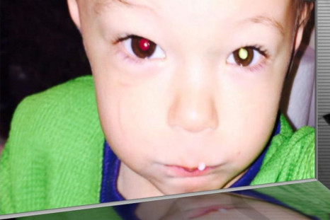 toddler's eye cancer