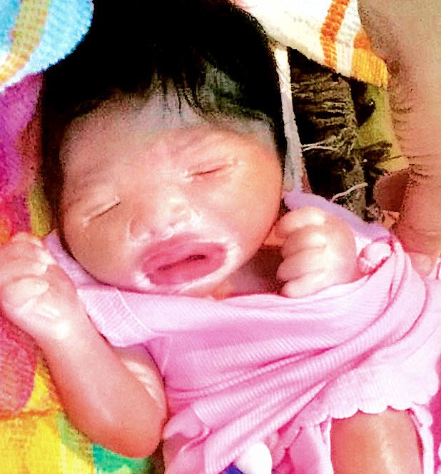 India: Tragic 'plastic baby' resembling rubber doll born 