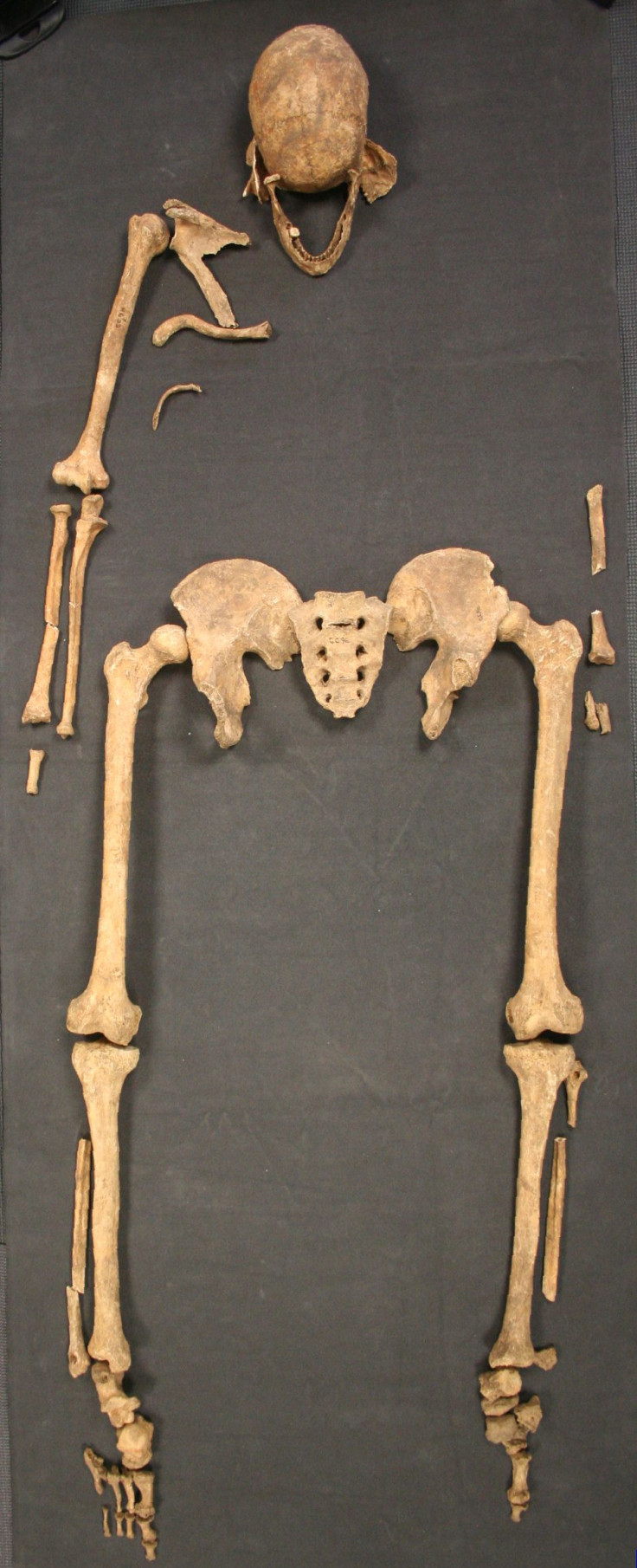 leprosy skeleton
