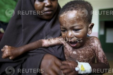 An internally displaced woman holds her malnourished son at the Banadir hospital in Somalia's capital Mogadishu