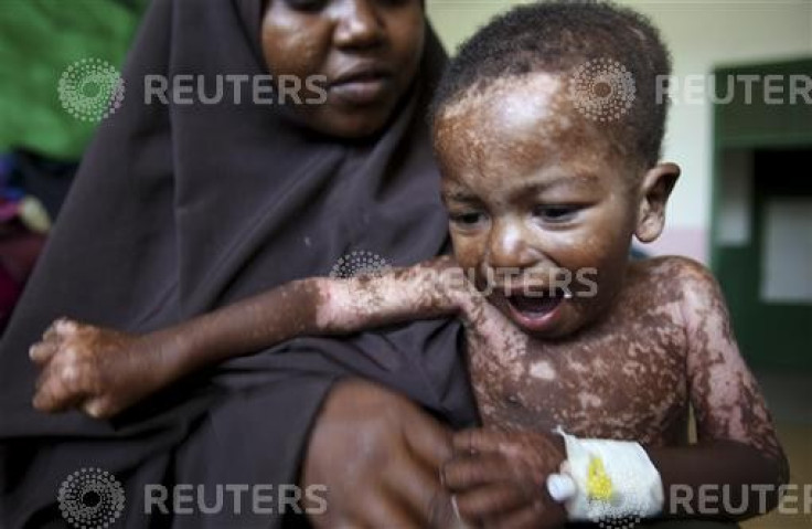 An internally displaced woman holds her malnourished son at the Banadir hospital in Somalia's capital Mogadishu