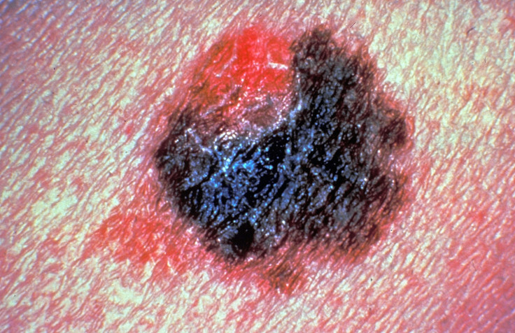 Skin cancer malignant melanoma