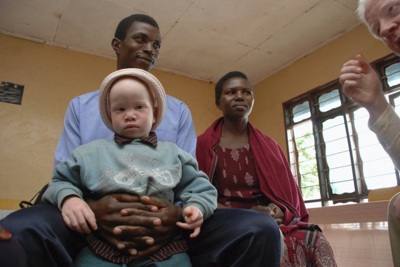 Albinism Tanzania