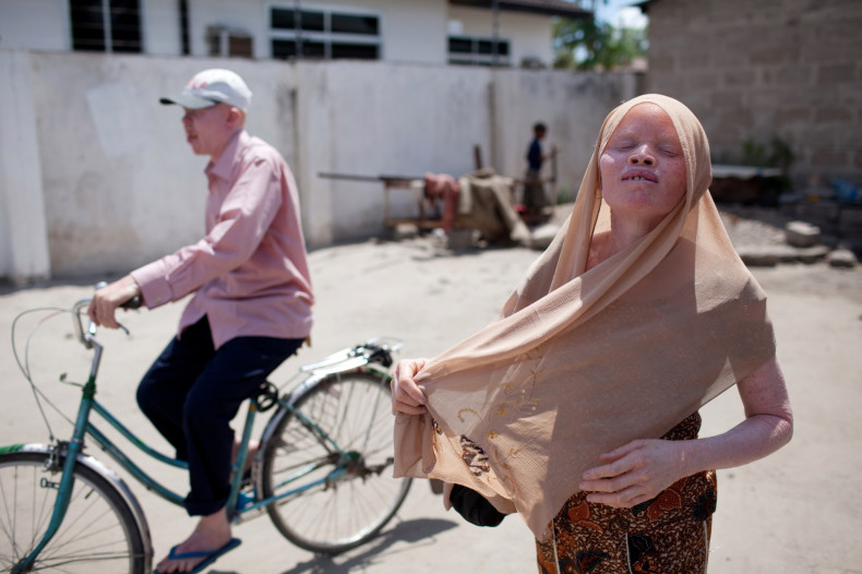 Tanzania albinism