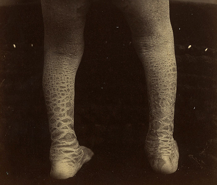 What is greyscale in Game of Thrones and is there a reallife equivalent illness?