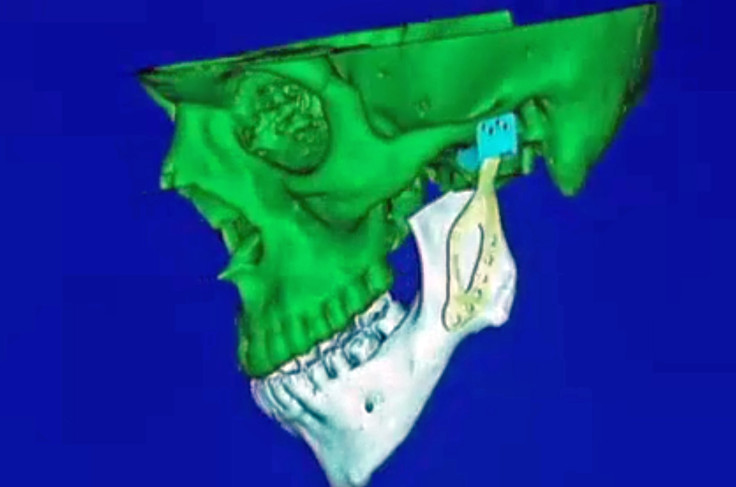 3D printed titanium prosthetic jaw joint bone