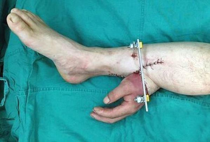 Severed hand attached for leg