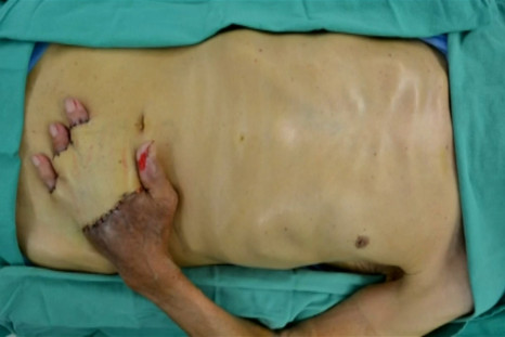 hand sewn into stomach