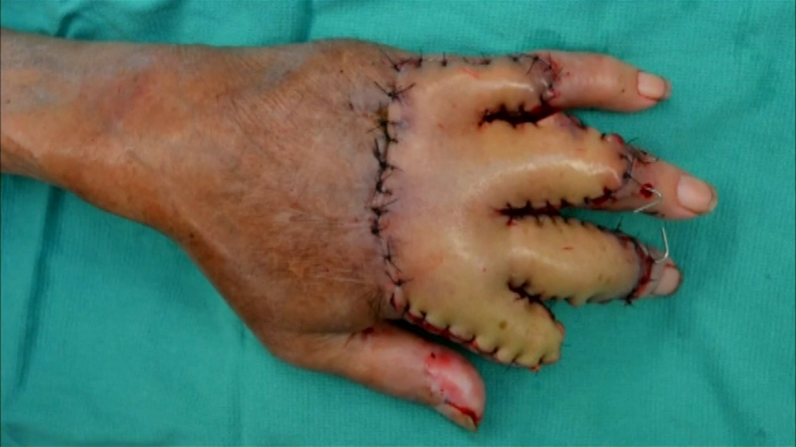 sewn hand into belly sewn hand into belly